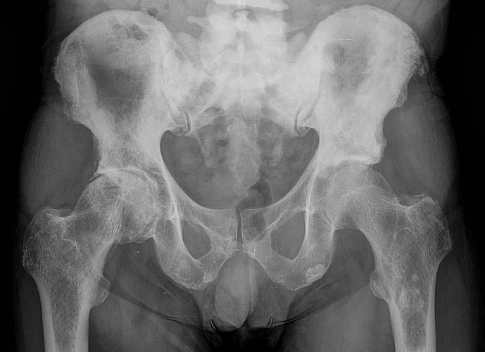 coxarthrose