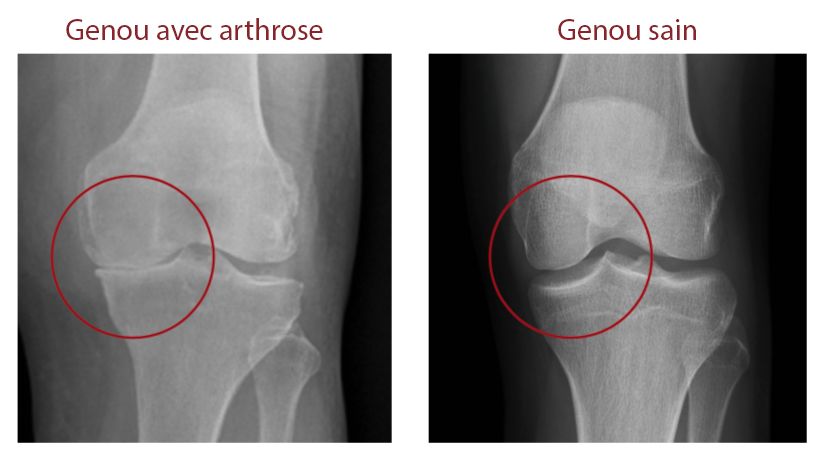 Dr Morais Chirurgien Orthopédiste Paris - Arthrose du genou